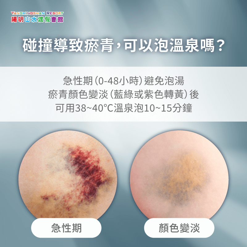 碰撞瘀青可以泡溫泉嗎-瘀青泡溫泉