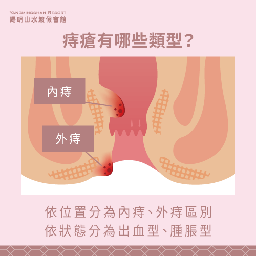 痔瘡種類-有痔瘡可以泡溫泉嗎